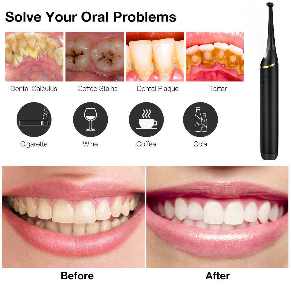 Professional Electric Teeth Cleaner Teeth Tartar Stains Remover- USB Charging