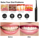 Professional Electric Teeth Cleaner Teeth Tartar Stains Remover- USB Charging